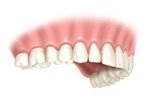 Dental implant cap completed